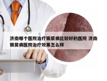 济南哪个医院治疗银屑病比较好的医院 济南银屑病医院治疗效果怎么样