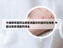 中国哪家医院治银屑病最好的医院在哪里 中国治银屑病医院排名