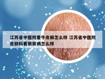 江苏省中医院看牛皮癣怎么样 江苏省中医院皮肤科看银屑病怎么样
