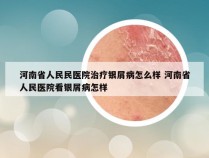 河南省人民民医院治疗银屑病怎么样 河南省人民医院看银屑病怎样
