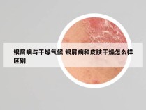 银屑病与干燥气候 银屑病和皮肤干燥怎么样区别