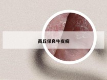商丘保良牛皮癣