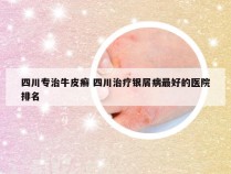 四川专治牛皮癣 四川治疗银屑病最好的医院排名