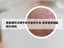 银屑病可以喝牛奶不能吃牛肉 患有银屑病能喝牛奶吗