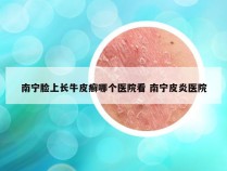南宁脸上长牛皮癣哪个医院看 南宁皮炎医院