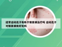 经常运动出汗有助于银屑病治疗吗 运动出汗对银屑病有好处吗