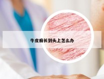 牛皮癣长到头上怎么办