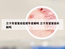 三个月宝宝会出现牛皮癣吗 三个月宝宝会长藓吗