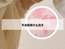 牛皮癣用什么洗手