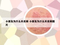 小朋友为什么长皮癣 小朋友为什么长皮癣图片