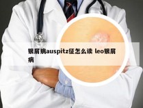 银屑病auspitz征怎么读 leo银屑病