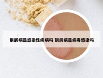 银屑病是感染性疾病吗 银屑病是病毒感染吗