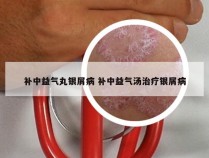 补中益气丸银屑病 补中益气汤治疗银屑病