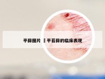平藓图片 萹平苔藓的临床表现