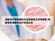 成都治疗银屑病的方法有哪些方法有哪些 成都银屑病医院治疗的怎么样