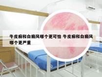 牛皮癣和白癜风哪个更可怕 牛皮癣和白癜风哪个更严重