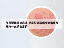 寻常型银屑病点滴 寻常型银屑病点滴状爆发期吃什么抗生素药