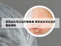 草药洗头可以治疗银屑病 草药洗头可以治疗银屑病吗
