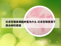 红皮型银屑病腿肿是为什么 红皮型银屑病下肢水肿的原因