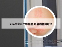 rna疗法治疗银屑病 银屑病基因疗法