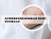 治疗银屑病单克隆抗体的制备过程 银屑病打单抗效果怎么样