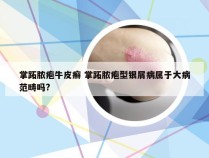 掌跖脓疱牛皮癣 掌跖脓疱型银屑病属于大病范畴吗?