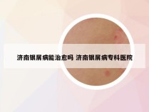 济南银屑病能治愈吗 济南银屑病专科医院
