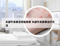 头部牛皮癣怎样能除根 头部牛皮肤癣治疗方法