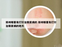 郑州哪里有打针治银屑病的 郑州哪里有打针治银屑病的地方