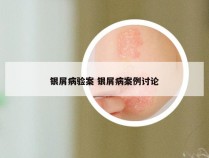 银屑病验案 银屑病案例讨论