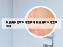 银屑病头皮可以用酒精吗 银屑病可以用酒精擦吗