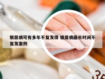 银屑病可有多年不复发得 银屑病最长时间不复发案例