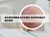 南京银屑病哪里治疗效果好 南京银屑病治疗最好医院