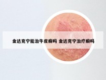 金达克宁能治牛皮癣吗 金达克宁治疗癣吗
