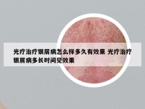 光疗治疗银屑病怎么样多久有效果 光疗治疗银屑病多长时间见效果