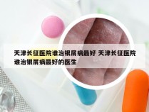 天津长征医院谁治银屑病最好 天津长征医院谁治银屑病最好的医生