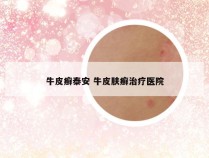 牛皮癣泰安 牛皮肤癣治疗医院