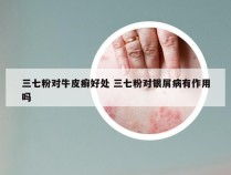 三七粉对牛皮癣好处 三七粉对银屑病有作用吗