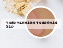 牛皮癣为什么到晚上就痒 牛皮银屑癣晚上痒怎么办