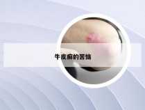 牛皮癣的苦恼