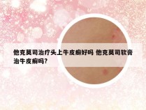 他克莫司治疗头上牛皮癣好吗 他克莫司软膏治牛皮癣吗?