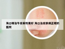 海口哪治牛皮癣效果好 海口治皮肤病正规的医院