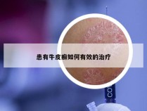 患有牛皮癣如何有效的治疗