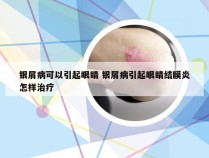 银屑病可以引起眼睛 银屑病引起眼睛结膜炎怎样治疗