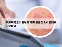 银屑病是怎么引起的 银屑病是怎么引起的会不会传染