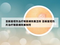 百藓夏塔热治疗银屑病效果怎样 百癣夏塔热片治疗银屑病效果如何
