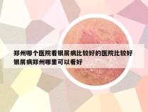 郑州哪个医院看银屑病比较好的医院比较好 银屑病郑州哪里可以看好