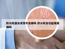 肝火旺盛会诱发牛皮癣吗 肝火旺会引起银屑病吗