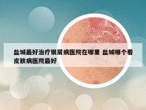 盐城最好治疗银屑病医院在哪里 盐城哪个看皮肤病医院最好