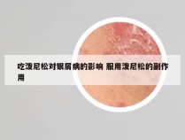 吃泼尼松对银屑病的影响 服用泼尼松的副作用